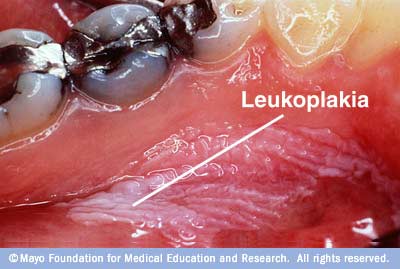 leukoplakia