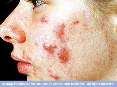 Cure for Cystic Acne