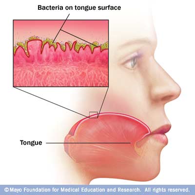 r7_halitosis.jpg