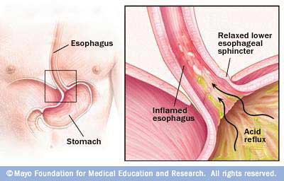 Picture showing how heartburn is caused. Picture showing how heartburn is caused.