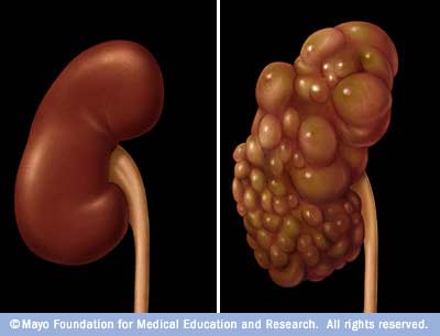 and autosomal dominant polycystic kidney