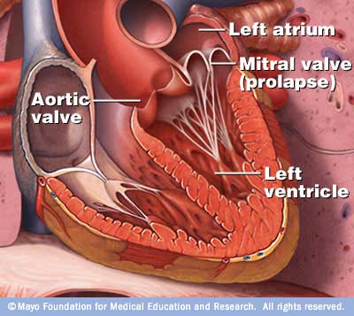 Mitral Valve Prolapse