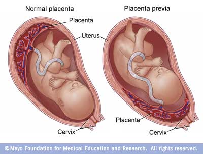 plazenta praevia